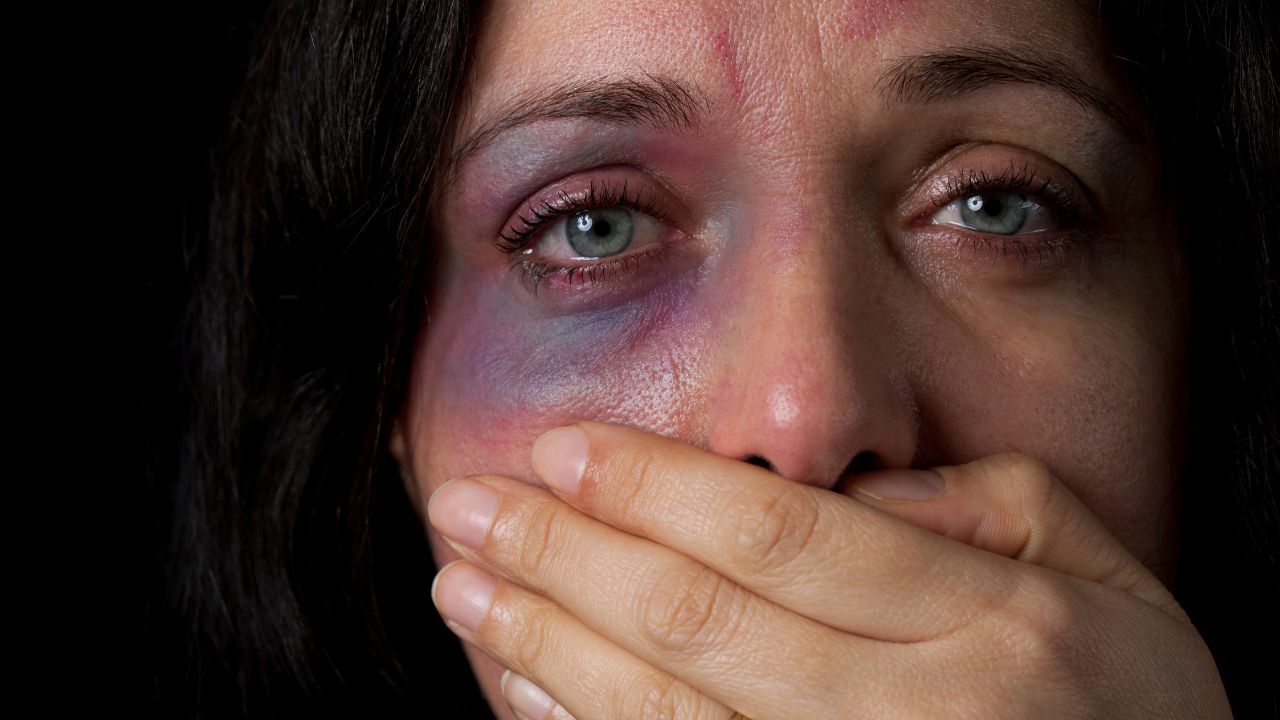 Nahaufnahme einer Frau mit einem blauen Auge und verletzter Haut, die sich mit der Hand den Mund zuhält, vor schwarzem Hintergrund.