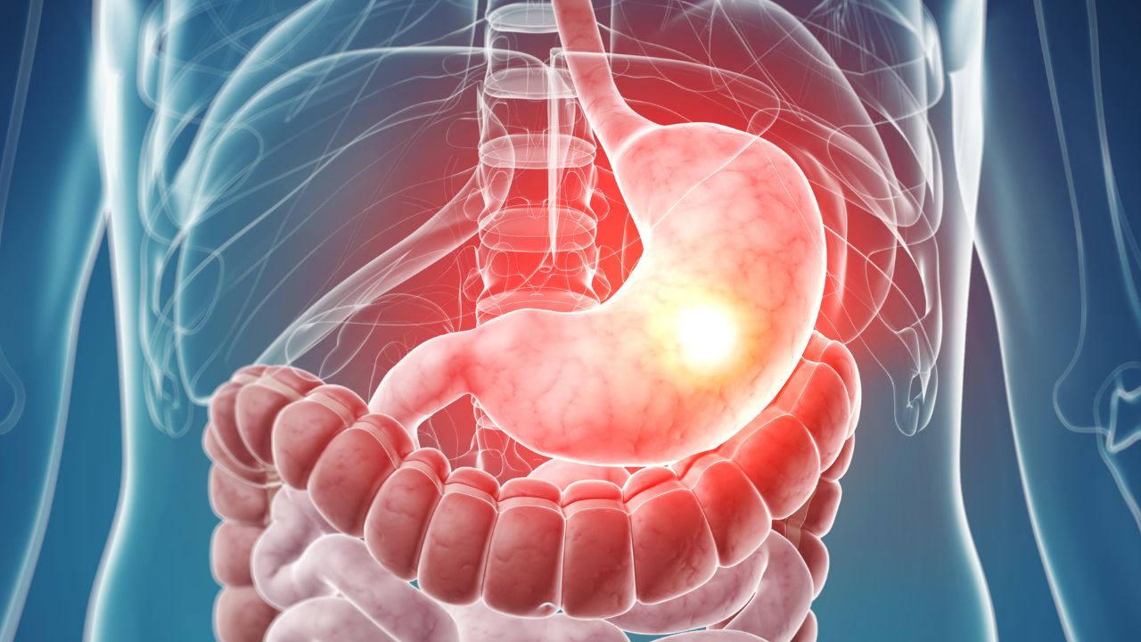 Medizinische 3D-Illustration des menschlichen Oberbauchs. Der Magen ist hervorgehoben und in Rot gefärbt, mit einem leuchtenden gelben Punkt an seiner Vorderseite, der auf eine Schmerzstelle oder Entzündung hinweist. Im Hintergrund sind die durchsichtig dargestellten Rippen und Teile des Darms zu sehen.